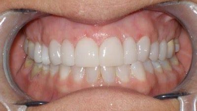 Panduan Dokter untuk Merawat Gigi agar Tidak Berlubang