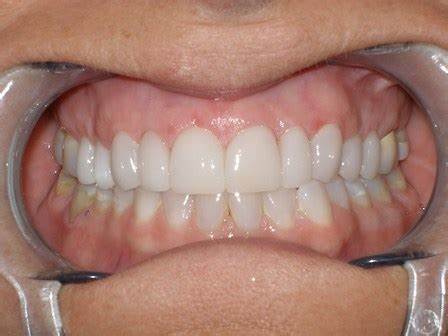 Panduan Dokter untuk Merawat Gigi agar Tidak Berlubang